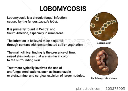 Lobomycosis, a chronic skin disease caused by microscopic fungi Lacazia loboi and characterized by nodular skin lesions, 3D illustration Lobomycosis, a chronic skin disease caused by microscopic fungi Lacazia loboi and characterized by nodular skin lesions, 3D illustration 103878905