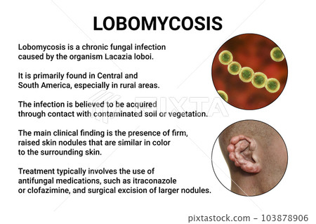 Lobomycosis, a chronic skin disease caused by microscopic fungi Lacazia loboi and characterized by nodular skin lesions, 3D illustration 103878906