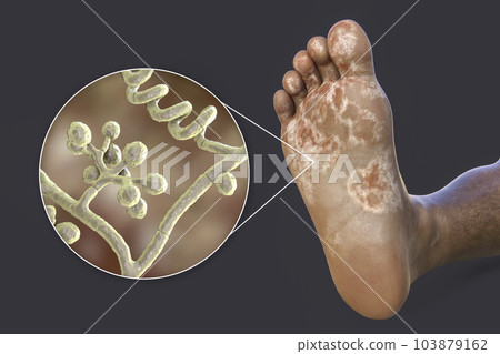 The foot with mycosis, and close-up view of fungi that cause Athlete's foot, 3d illustration The foot with mycosis, and close-up view of fungi that cause Athlete's foot, 3d illustration 103879162