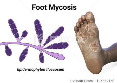 The foot with mycosis, and close-up view of fungi that cause Athlete's foot, 3d illustration The foot with mycosis, and close-up view of fungi that cause Athlete's foot, 3d illustration 103879170