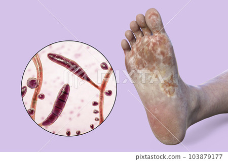 The foot with mycosis, and close-up view of fungi Trichophyton rubrum, 3d illustration The foot with mycosis, and close-up view of fungi Trichophyton rubrum, 3d illustration 103879177
