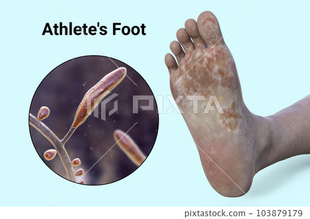 The foot with mycosis, and close-up view of fungi Trichophyton rubrum, 3d illustration The foot with mycosis, and close-up view of fungi Trichophyton rubrum, 3d illustration 103879179