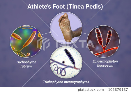 The foot with mycosis, and close-up view of fungi that cause Athlete's foot, 3d illustration 103879187