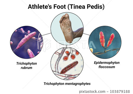 The foot with mycosis, and close-up view of fungi that cause Athlete's foot, 3d illustration The foot with mycosis, and close-up view of fungi that cause Athlete's foot, 3d illustration 103879188