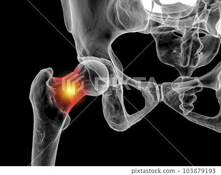 A fracture of the femur neck, a common type of hip fracture that typically occurs in older adults and can lead to mobility issues and other complications, 3D illustration 103879193
