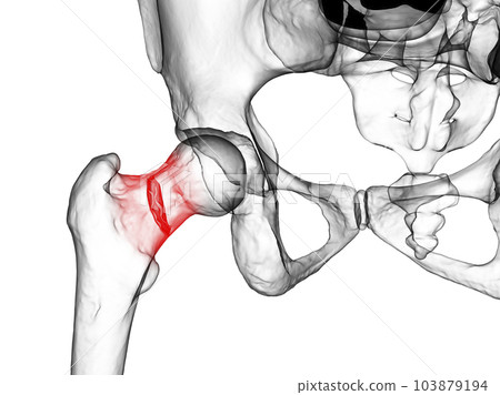 A fracture of the femur neck, a common type of hip fracture that typically occurs in older adults and can lead to mobility issues and other complications, 3D illustration 103879194
