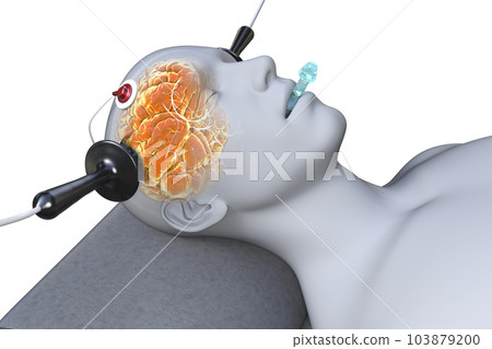 Electroconvulsive therapy, ECT, a treatment involving the use of electrical currents to stimulate the brain, 3D illustration Electroconvulsive therapy, ECT, a treatment involving the use of electrical currents to stimulate the brain, 3D illustration 103879200