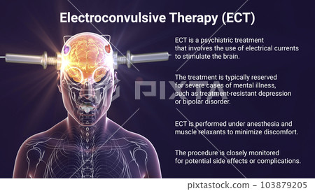 Electroconvulsive therapy, ECT, a treatment involving the use of electrical currents to stimulate the brain, 3D illustration Electroconvulsive therapy, ECT, a treatment involving the use of electrical currents to stimulate the brain, 3D illustration 103879205