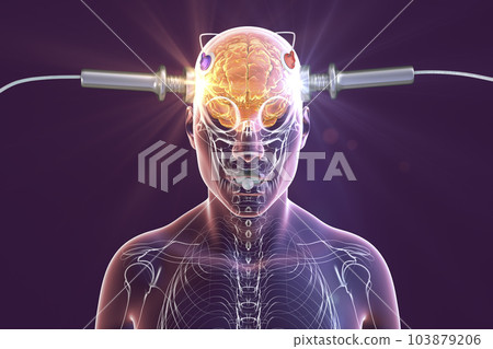 Electroconvulsive therapy, ECT, a treatment involving the use of electrical currents to stimulate the brain, 3D illustration Electroconvulsive therapy, ECT, a treatment involving the use of electrical currents to stimulate the brain, 3D illustration 103879206