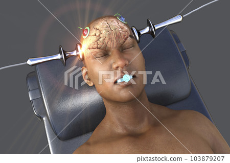 Electroconvulsive therapy, ECT, a treatment involving the use of electrical currents to stimulate the brain, 3D illustration Electroconvulsive therapy, ECT, a treatment involving the use of electrical currents to stimulate the brain, 3D illustration 103879207