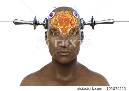 Electroconvulsive therapy, ECT, a treatment involving the use of electrical currents to stimulate the brain, 3D illustration Electroconvulsive therapy, ECT, a treatment involving the use of electrical currents to stimulate the brain, 3D illustration 103879213