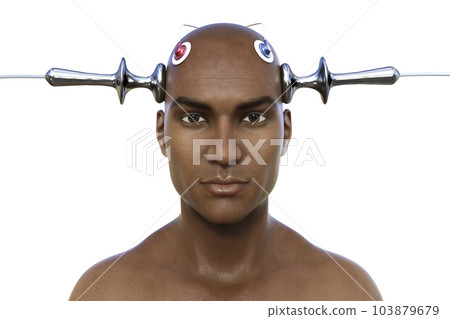 Electroconvulsive therapy, ECT, a treatment involving the use of electrical currents to stimulate the brain, 3D illustration Electroconvulsive therapy, ECT, a treatment involving the use of electrical currents to stimulate the brain, 3D illustration 103879679