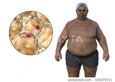 A senior overweight man with a close-up view of adipocytes, 3D illustration highlighting the role of these fat cells in obesity 103879713