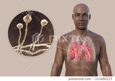 A 3D illustration of the upper half part of an African man with transparent skin, revealing a lung mucormycosis lesion, with close-up view of Rhizopus fungi A 3D illustration of the upper half part of an African man with transparent skin, revealing a lung mucormycosis lesion, with close-up view of Rhizopus fungi 103880225