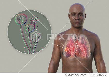 A 3D illustration of the upper half part of an African man with transparent skin, revealing a lung mucormycosis lesion, with close-up view of Mucor fungi A 3D illustration of the upper half part of an African man with transparent skin, revealing a lung mucormycosis lesion, with close-up view of Mucor fungi 103880227