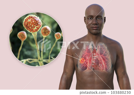 A 3D illustration of the upper half part of an African man with transparent skin, revealing a lung mucormycosis lesion, with close-up view of Mucor fungi 103880230