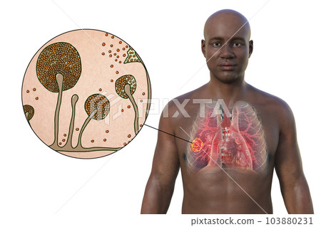 A 3D illustration of the upper half part of an African man with transparent skin, revealing a lung mucormycosis lesion, with close-up view of Mucor fungi A 3D illustration of the upper half part of an African man with transparent skin, revealing a lung mucormycosis lesion, with close-up view of Mucor fungi 103880231