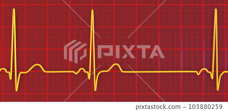 Electrocardiogram ECG displaying sinus arrhythmia, 3D illustration Electrocardiogram ECG displaying sinus arrhythmia, 3D illustration 103880259