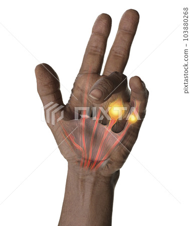 Hand of a male patient with Dupuytren's contracture, photorealistic 3D illustration 103880268