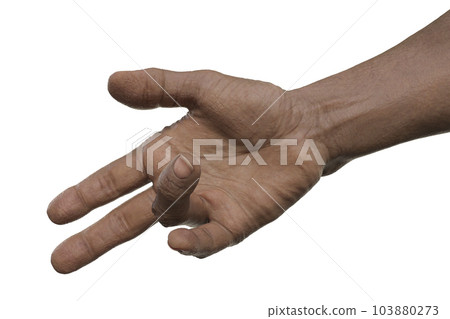 Hand of a male patient with Dupuytren's contracture, photorealistic 3D illustration 103880273