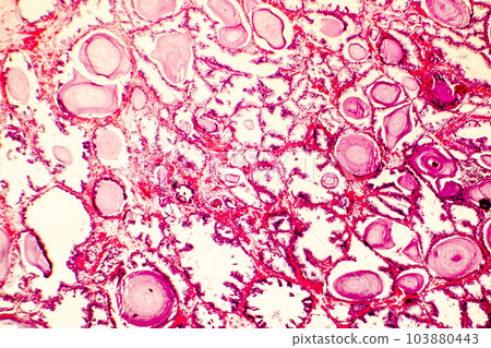 Photomicrograph of prostate hyperplasia Photomicrograph of prostate hyperplasia 103880443