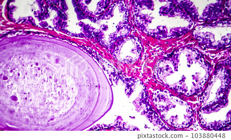 Histopathology of prostate gland hyperplasia Histopathology of prostate gland hyperplasia 103880448
