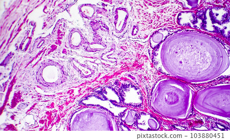 Histopathology of prostate gland hyperplasia Histopathology of prostate gland hyperplasia 103880451