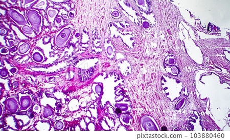 Histopathology of prostate gland hyperplasia Histopathology of prostate gland hyperplasia 103880460