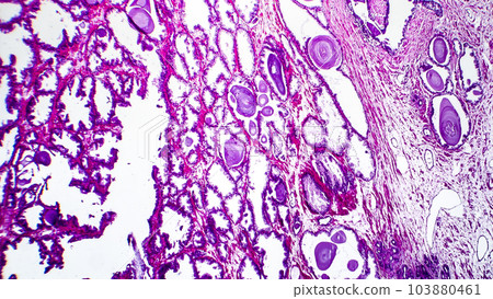 Histopathology of prostate gland hyperplasia Histopathology of prostate gland hyperplasia 103880461