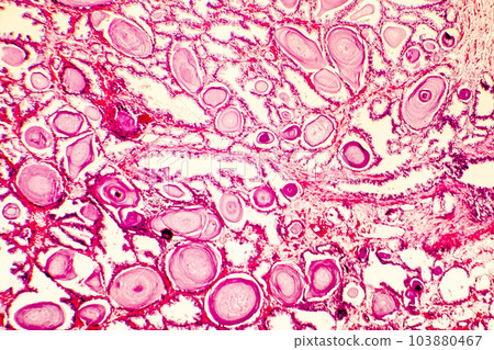 Photomicrograph of prostate hyperplasia 103880467
