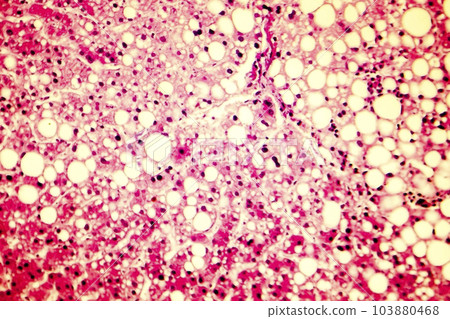 Light micrograph of a fatty liver 103880468