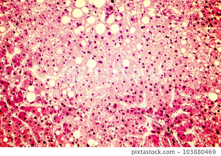 Light micrograph of a fatty liver 103880469