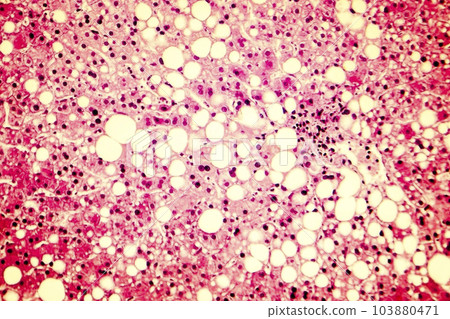 Light micrograph of a fatty liver 103880471