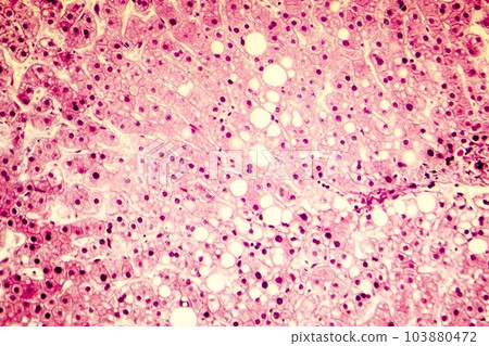Light micrograph of a fatty liver 103880472