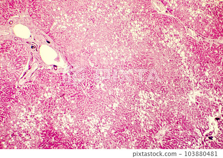 Light micrograph of a fatty liver 103880481