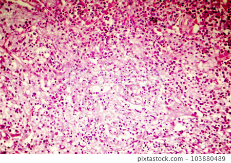 Liquefactive necrosis of the human brain, light photomicrograph 103880489