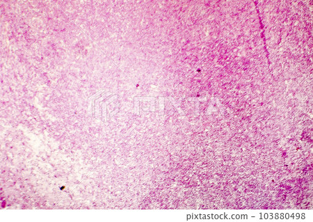 Liquefactive necrosis of the human brain, light photomicrograph Liquefactive necrosis of the human brain, light photomicrograph 103880498