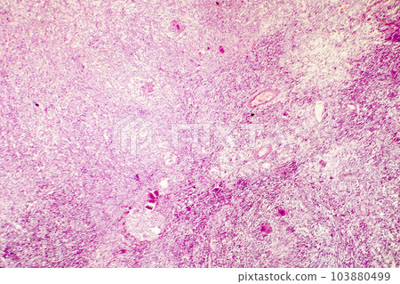 Liquefactive necrosis of the human brain, light photomicrograph Liquefactive necrosis of the human brain, light photomicrograph 103880499