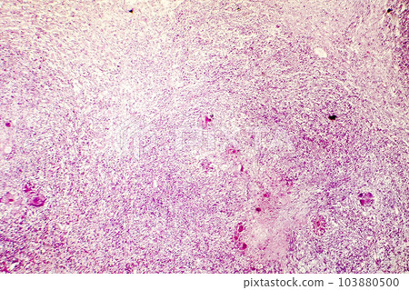 Liquefactive necrosis of the human brain, light photomicrograph Liquefactive necrosis of the human brain, light photomicrograph 103880500
