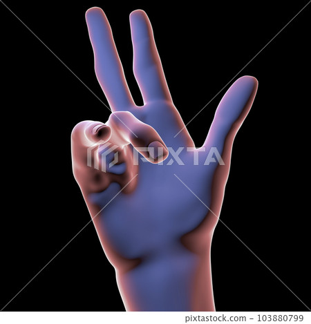 Hand of a patient with Dupuytren's contracture, 3D illustration Hand of a patient with Dupuytren's contracture, 3D illustration 103880799
