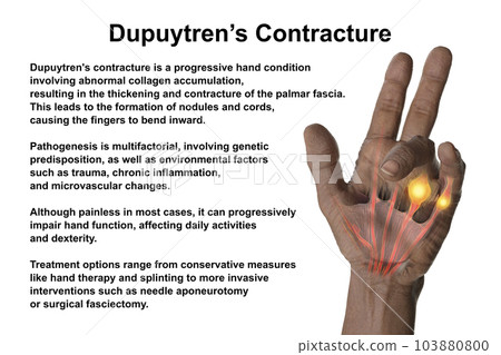A 3D medical illustration displaying a patient's hand with Dupuytren's contracture, emphasizing the affected tendons and palmar fascia A 3D medical illustration displaying a patient's hand with Dupuytren's contracture, emphasizing the affected tendons and palmar fascia 103880800