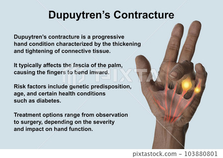 A 3D medical illustration displaying a patient's hand with Dupuytren's contracture, emphasizing the affected tendons and palmar fascia A 3D medical illustration displaying a patient's hand with Dupuytren's contracture, emphasizing the affected tendons and palmar fascia 103880801