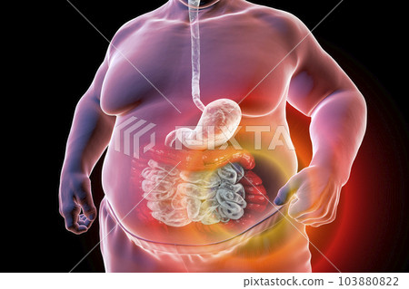 A 3D medical illustration depicting the upper half part of a senior obese male body with a highlighted digestive system, showcasing large bowel spasms A 3D medical illustration depicting the upper half part of a senior obese male body with a highlighted digestive system, showcasing large bowel spasms 103880822