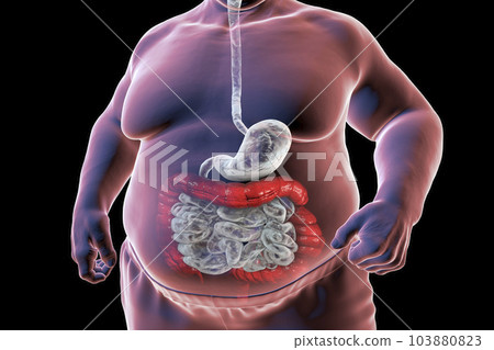 A 3D medical illustration depicting the upper half part of a senior obese male body with a highlighted digestive system, showcasing large bowel spasms 103880823
