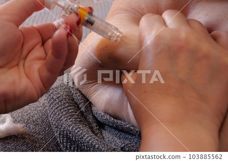 Woman is injecting hormones to belly with syringe. IVF concept close up Woman is injecting hormones to belly with syringe. IVF concept close up 103885562