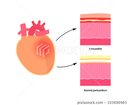 Pericarditis heart disease 103890965