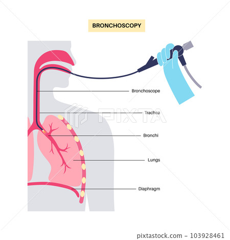 Bronchoscopy procedure concept Bronchoscopy procedure concept 103928461
