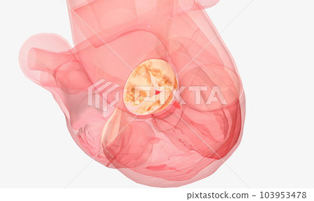 aortic regurgitation or aortic regurgitation aortic regurgitation or aortic regurgitation 103953478