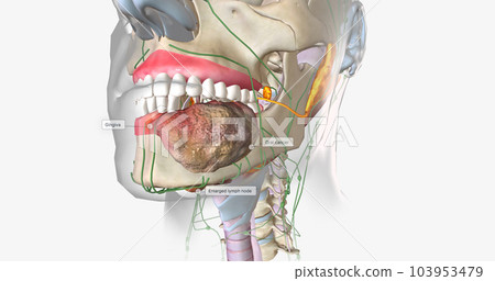 Once a tumor has spread into nearby lymph nodes, it is considered a stage three cancer. Once a tumor has spread into nearby lymph nodes, it is considered a stage three cancer. 103953479