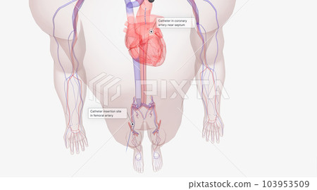 Using a local anesthetic, a catheter is inserted into a vein or artery near the groin. 103953509